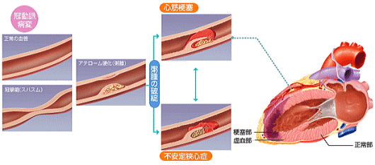 冠動脈病変