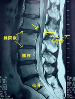 椎間板ヘルニア