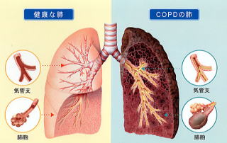 copd