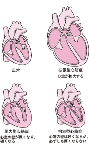 心筋症