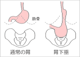 胃下垂