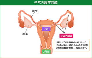 子宮内膜症