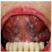 舌下脈絡