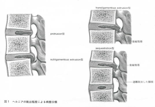 腰椎ヘルニア