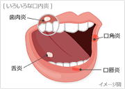 口内炎