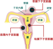 子宮筋腫