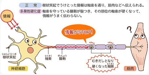 多発性硬化症