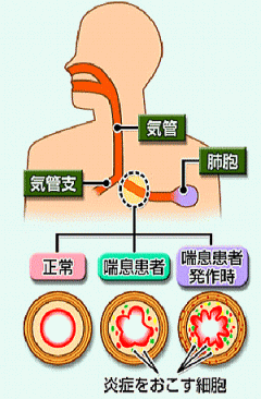 気管支喘息