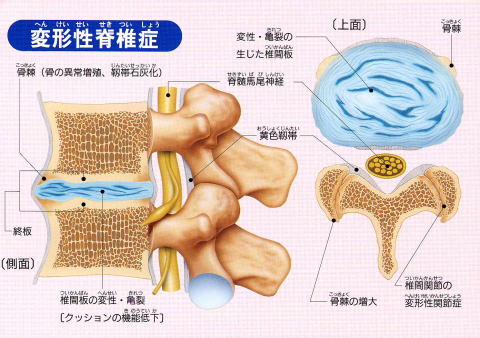 変形性脊椎症