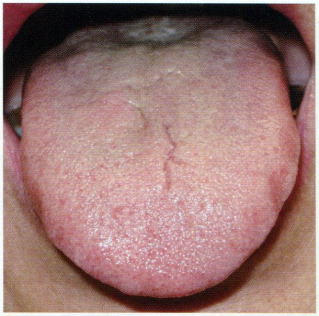 舌診 舌診とは 埼玉県川口市の石上鍼灸院ブログ