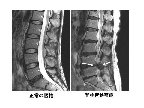 脊柱管狭窄