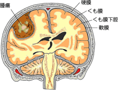 脳腫瘍